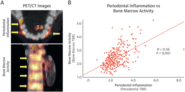 Diagram Periodontal inflammation vs Bone Marrow Activity